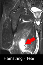 F  HUBSPOT hamstring tear