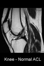 Knee Normal ACL