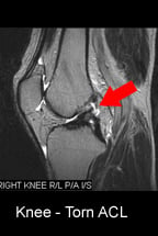 Knee Torn ACL