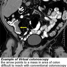 F  HUBSPOT v colonoscopy