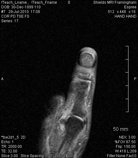 ulnar collateral ligament thumb mri