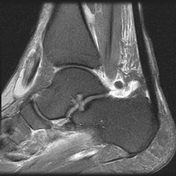 Normal Plantar Fascia