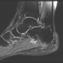 Plantar Fascia Imaging