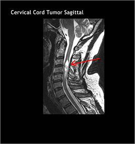 Cervial Cord Tumor Sagittal resized 600