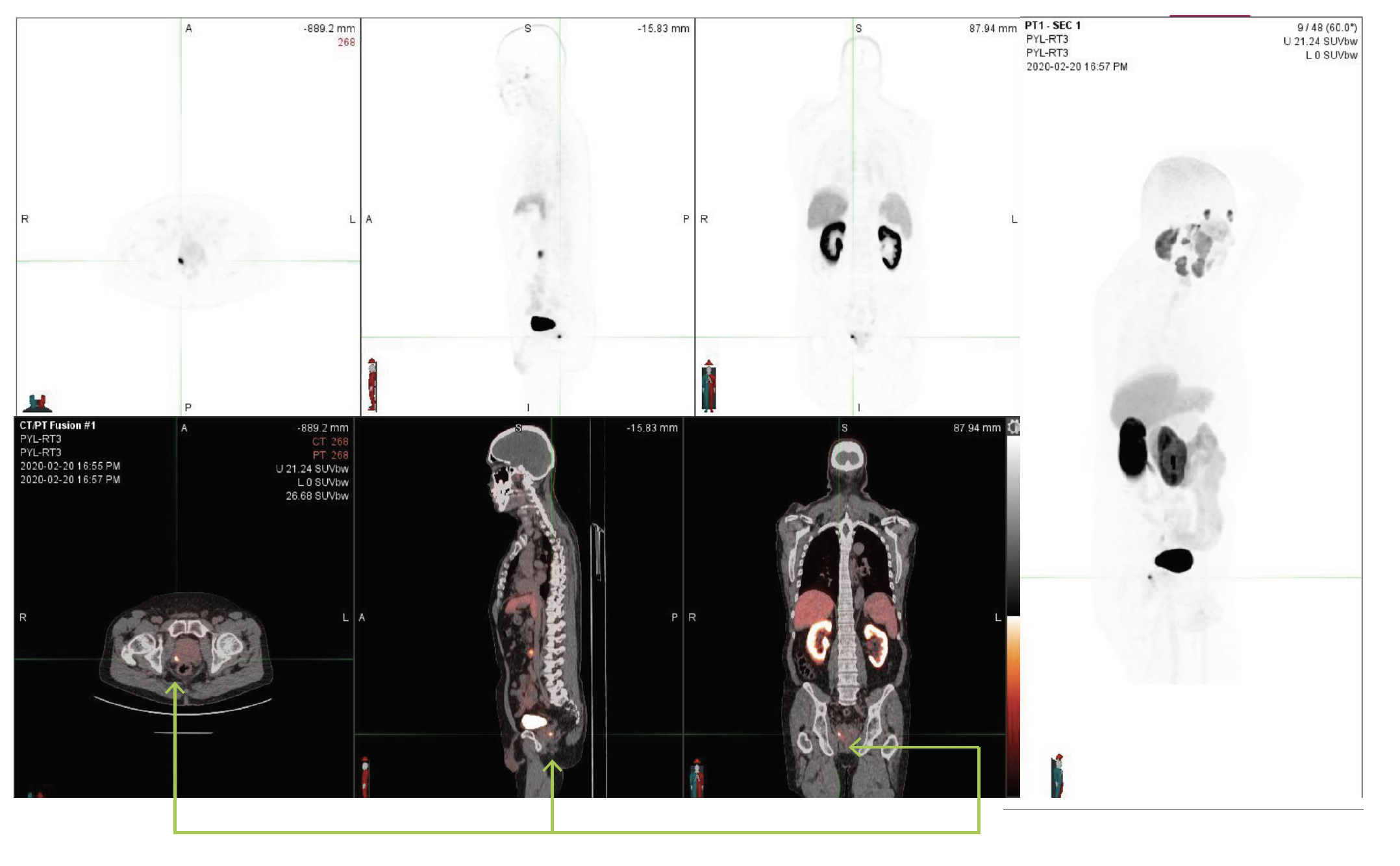 Case Study: The impact of PSMA PET/CT for Initial Staging