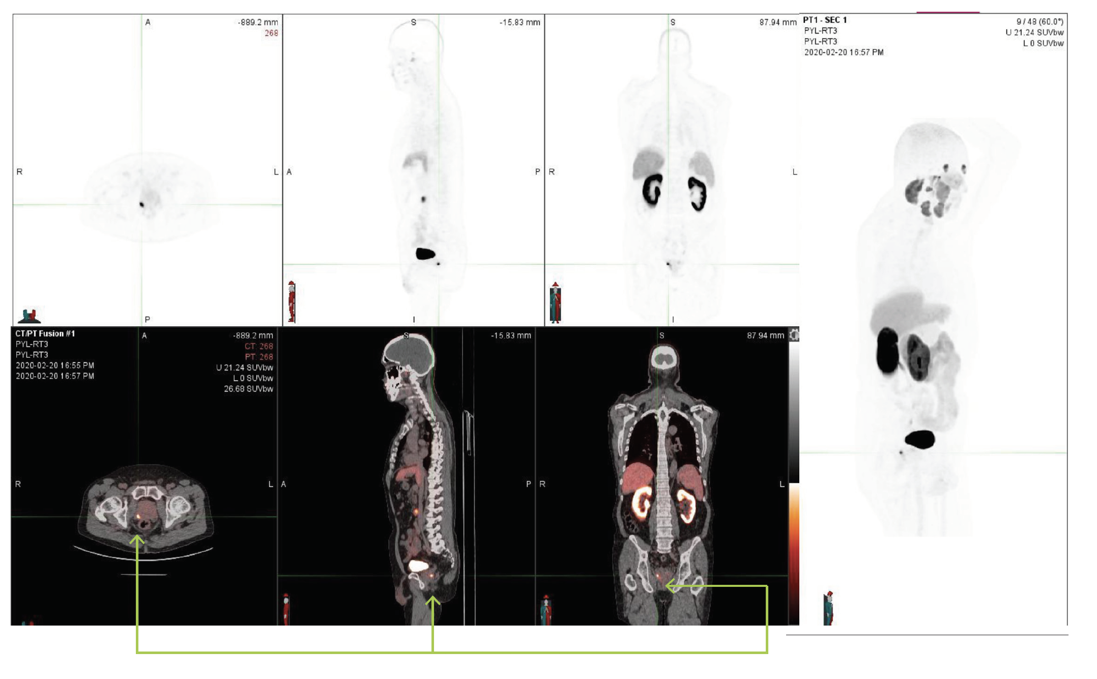 PSMA PET/CT Image - Case Study 1