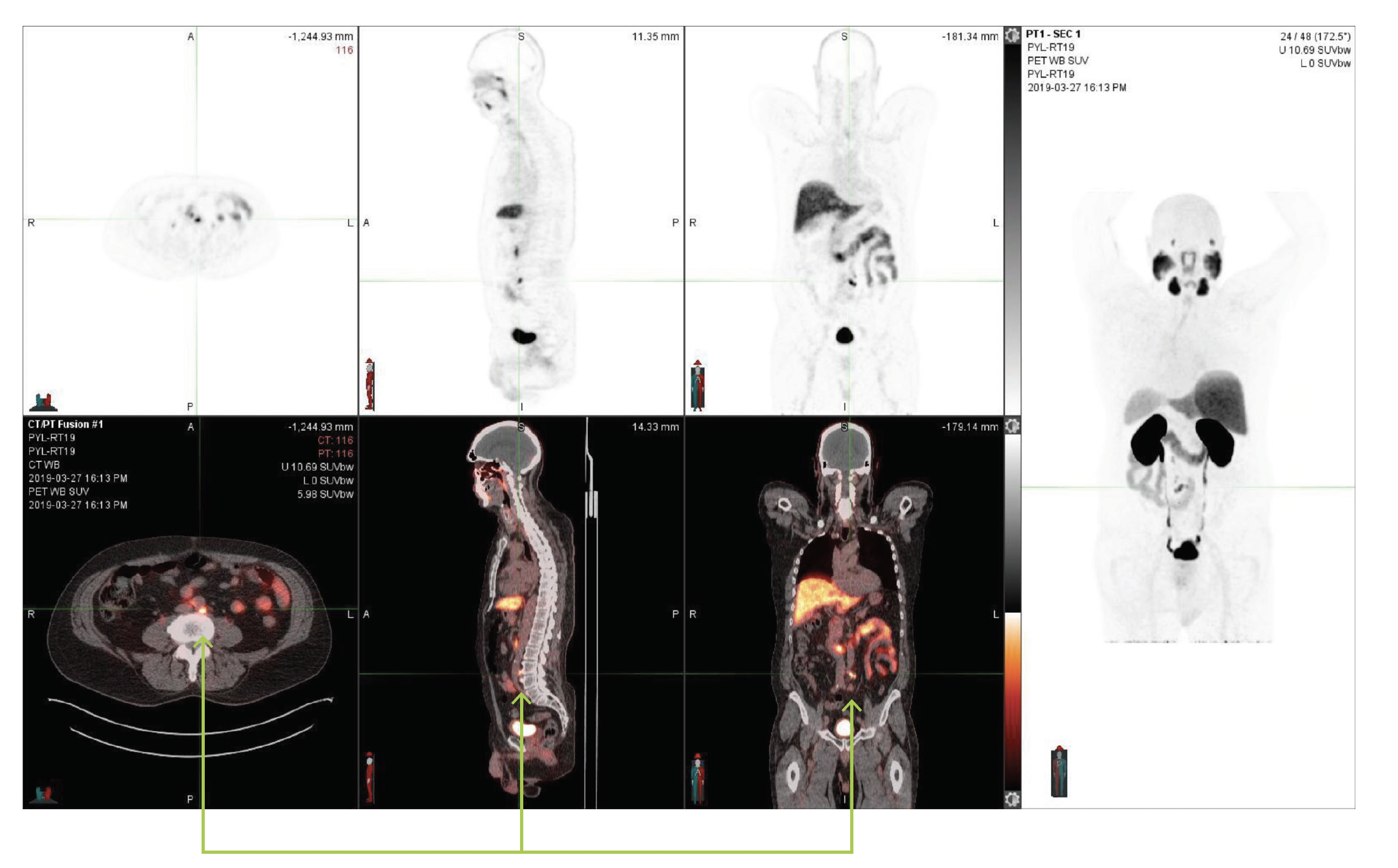 PSMA PET/CT Images: Case Study 2