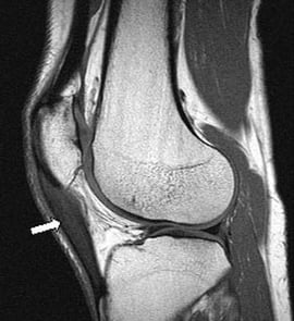 Spring runners: Beware increased mileage. MRI and Patellar Tendonitis.