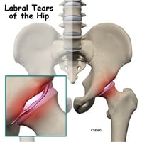 labral tear again & again