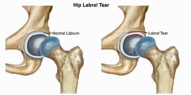 labral tear again