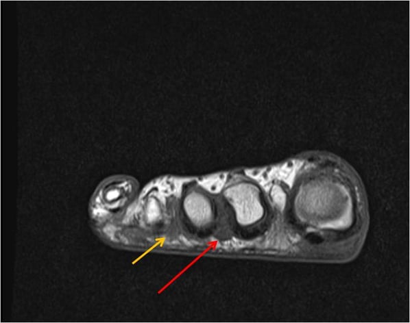 mortons_neuroma.jpg